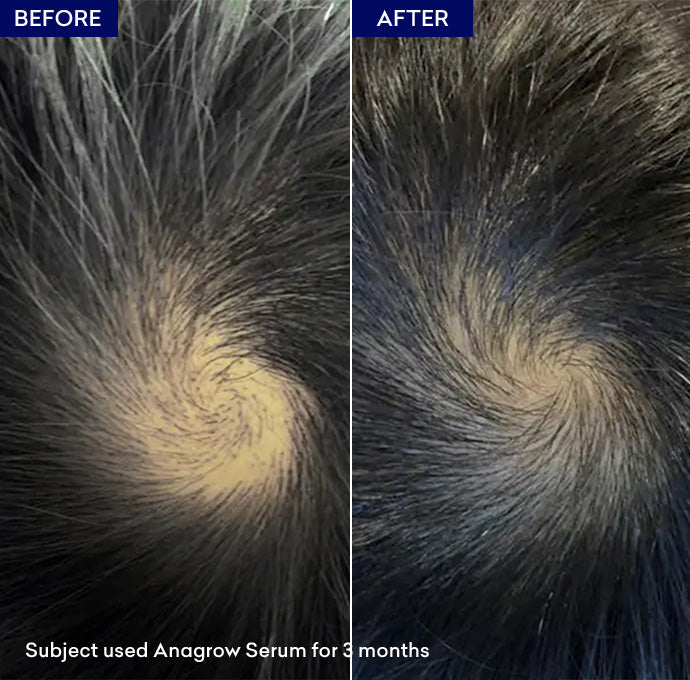 hair growth serum for men