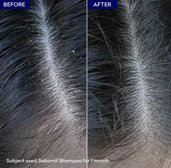 dandruff shampoo
