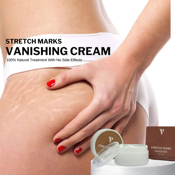 Stretch Mark Vanishing Cream