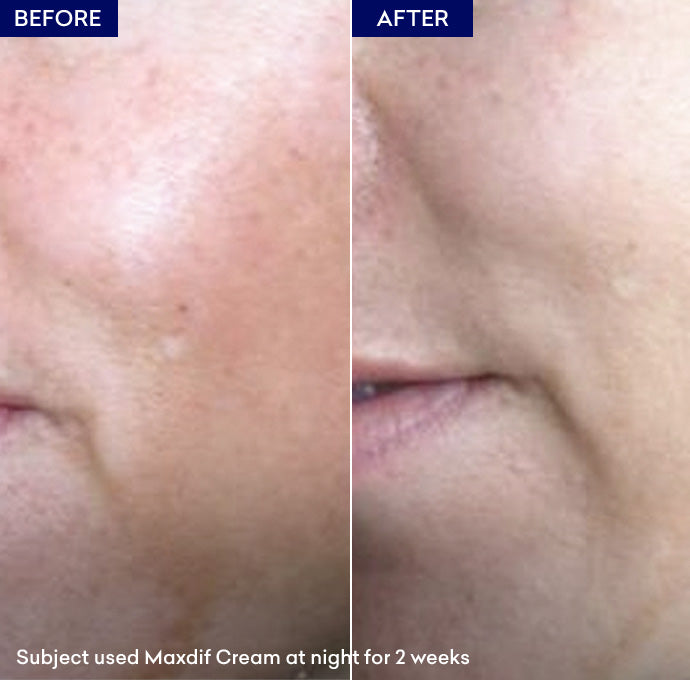 whitening cream
